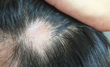 La caída del cabello causada por el coronavirus suele ser temporal.