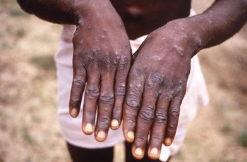 Manos de un paciente con viruela del mono en la República Democrática del Congo; 1997