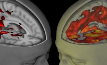 Resonancia magnética funcional de los cerebros de una persona bajo los efectos del LSD